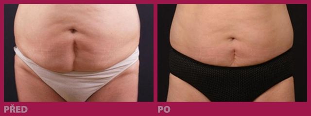 lipo06