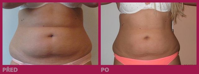 lipo07