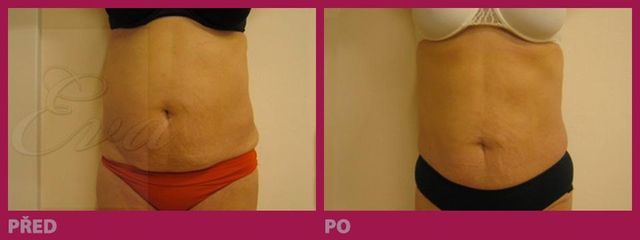 lipo08