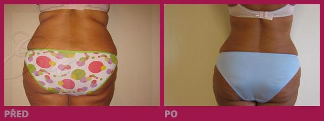 lipo09