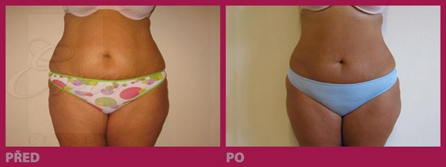lipo11