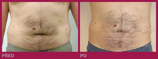 lipo12