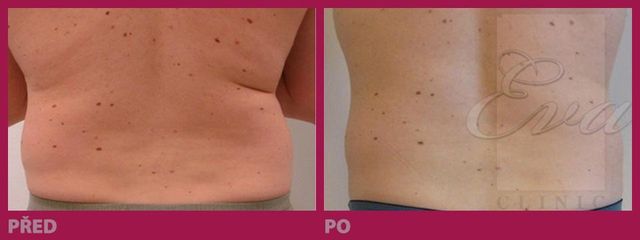 lipo13