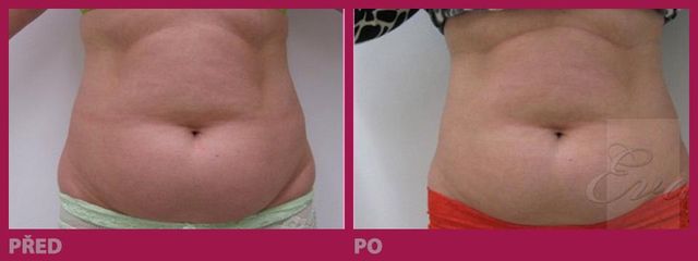 lipo14