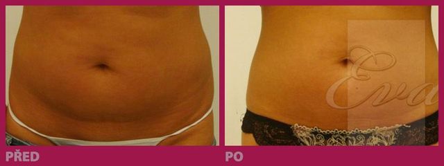 lipo15