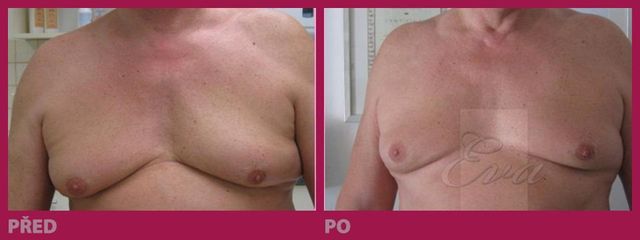 lipo16