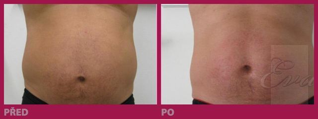 lipo17