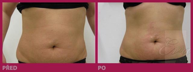 lipo18