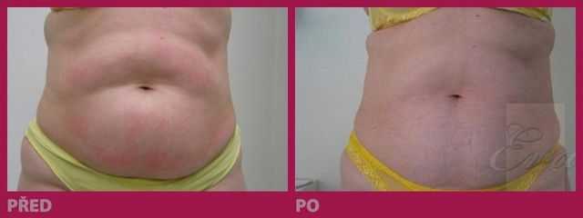 lipo19