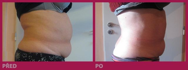 lipo20