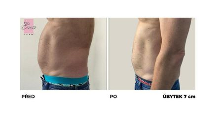 EMSCULPT - EVA CLINIC s.r.o.