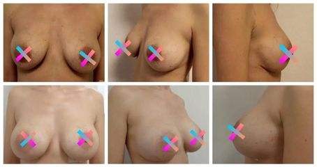 Reaugmentace