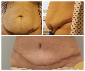 BEFORE abdominoplastika pred po 4 tydny po operaci