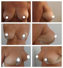 Breast-lift