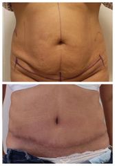 BEFORE abdominoplastika pred po 6 tydnu po operaci