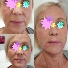 BEFORE ha filler2