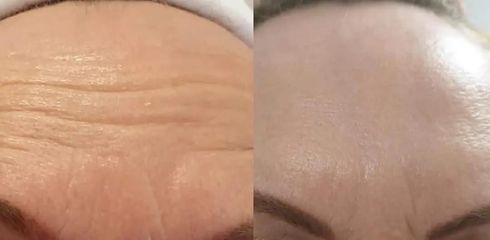Odstranění vrásek na čele botulotoxin - Plastická a estetická chirurgie Poděbrady - prim. MUDr. Veli