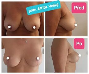 BEFORE modelace prsu po tehotenstvi a kojeni
