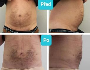BEFORE liposukce muzskeho bricha