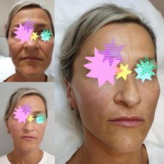 BEFORE ha filler1