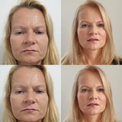 Botox - Kyselina hyaluronová - Plastická a estetická chirurgie Poděbrady - prim. MUDr. Veliký