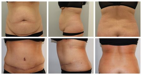 Abdominoplastika 5 týdnů PO - Plastická a estetická chirurgie Poděbrady - prim. MUDr. Veliký