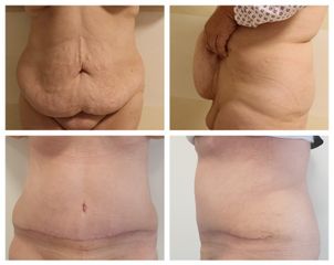 Abdominoplastika 5 týdnů PO - Plastická a estetická chirurgie Poděbrady - prim. MUDr. Veliký