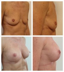 Augmentace - Plastická a estetická chirurgie Poděbrady - prim. MUDr. Veliký
