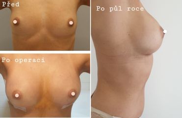Augmentace - Plastická a estetická chirurgie Poděbrady - prim. MUDr. Veliký