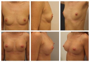 Augmentace - Plastická a estetická chirurgie Poděbrady - prim. MUDr. Veliký