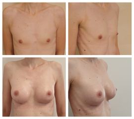 Augmentace - Plastická a estetická chirurgie Poděbrady - prim. MUDr. Veliký