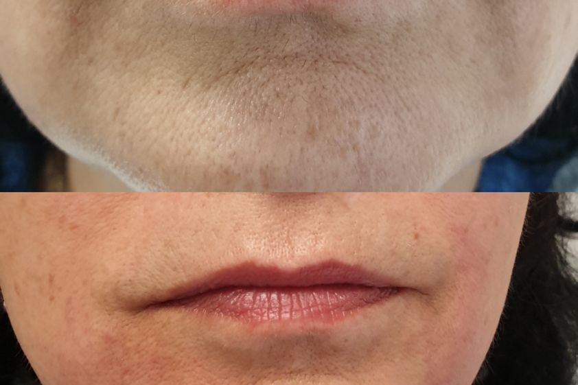 Antiaging před a po - 739858