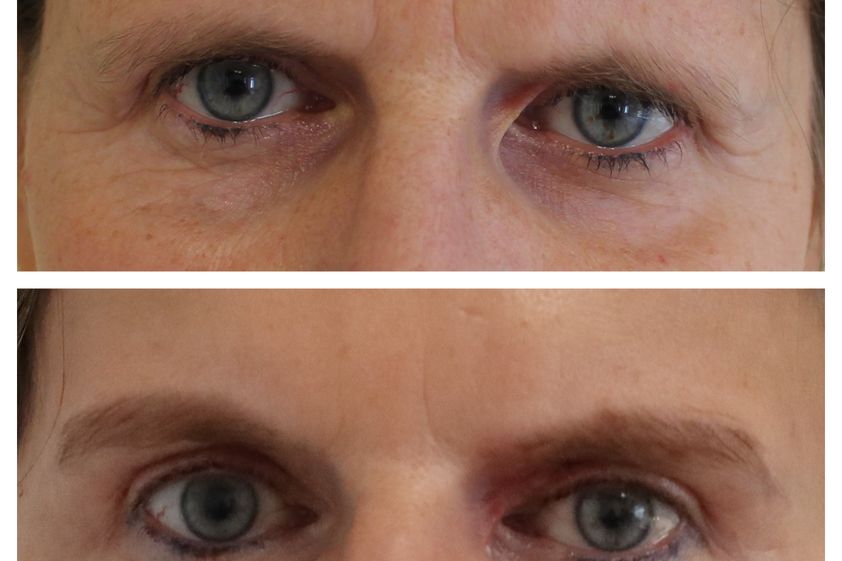 Brow lift před a po - 739865