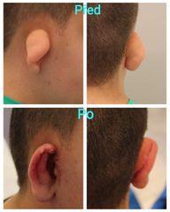 Korekce deformity ucha - Plastická a estetická chirurgie Poděbrady - prim. MUDr. Veliký