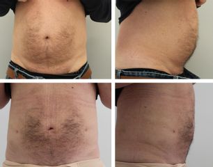 Liposukce břicha - Plastická a estetická chirurgie Poděbrady - prim. MUDr. Veliký