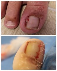 Plastika nehtového lůžka - Plastická a estetická chirurgie Poděbrady - prim. MUDr. Veliký