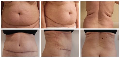 abdominoplastika 5 týdnů PO - Plastická a estetická chirurgie Poděbrady - prim. MUDr. Veliký