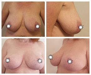 Zmenšení prsou - Plastická a estetická chirurgie Poděbrady - prim. MUDr. Veliký