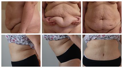 Operace břicha - Plastická a estetická chirurgie Poděbrady - prim. MUDr. Veliký
