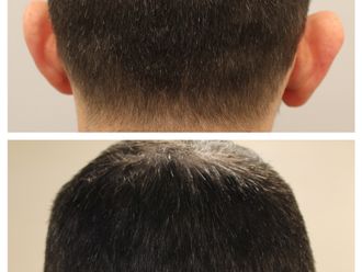Otoplastika - 786689