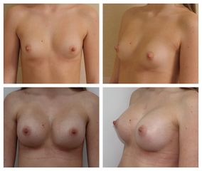Zvětšení prsou - Plastická a estetická chirurgie Poděbrady - prim. MUDr. Veliký