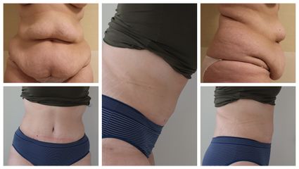 abdominoplastika 4 měsíce od operace - prim. MUDr. Veliký