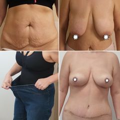 Abdominoplastika - prim. MUDr. Veliký