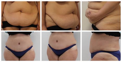 Abdominoplastika - prim. MUDr. Veliký