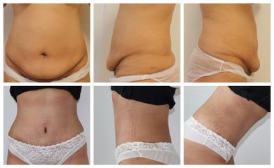 Abdominoplastika - prim. MUDr. Veliký