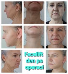 Facelift - prim. MUDr. Veliký