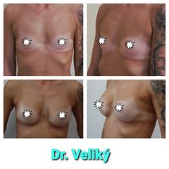 Zvětšení prsou - Plastická a estetická chirurgie Poděbrady - prim. MUDr. Veliký