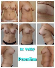Abdominoplastika - Plastická a estetická chirurgie Poděbrady - prim. MUDr. Veliký