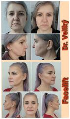 Facelift - prim. MUDr. Veliký