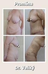 Mommy makeover - prim. MUDr. Veliký